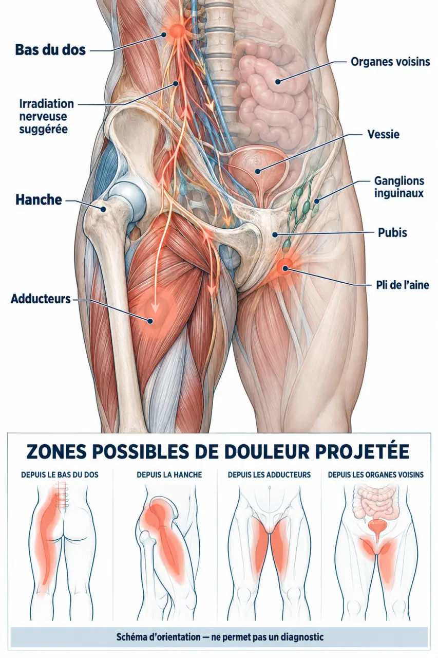Schéma anatomique des douleurs aux aines et des zones voisines pouvant être à l’origine d’une douleur inguinale